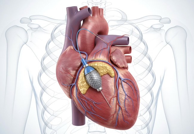 Coronary Angiography (CAG)
